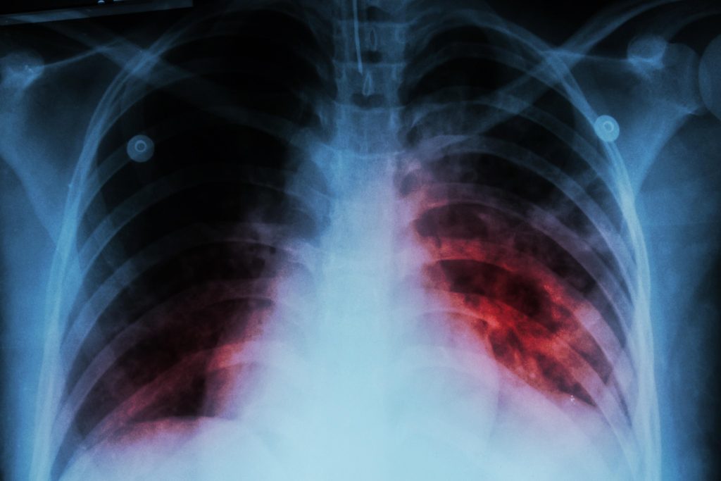 Tuberculosis share