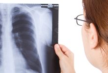 د نري رنځ نړیواله ورځ او په افغانستان کې د څه باندې ۵۰ زره کسانو درملنه