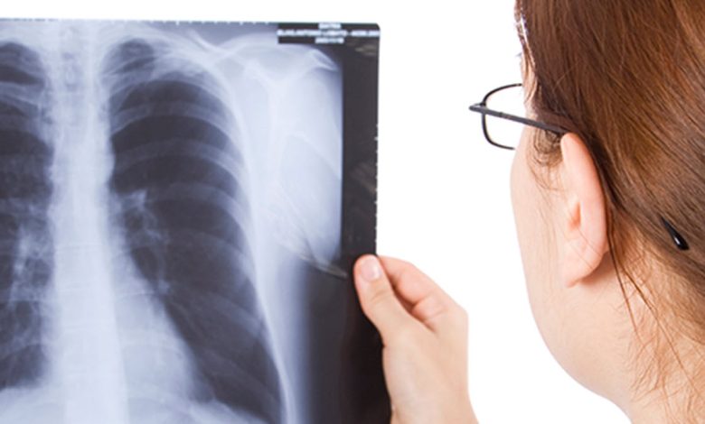 د نري رنځ نړیواله ورځ او په افغانستان کې د څه باندې ۵۰ زره کسانو درملنه