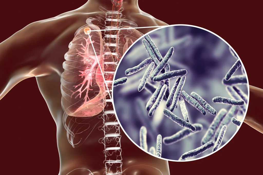 Secondary tuberculosis in lungs and close up view of Mycobacterium tuberculosis bacteria